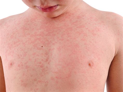 meningitis rash no other symptoms